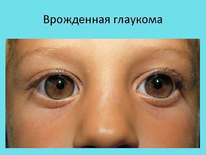 Глаукома симптомы признаки и причины лечение у взрослых фото