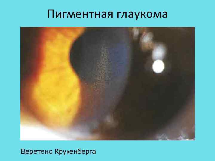 Дисперсия глаза. Пигментная открытоугольная глаукома. Веретено Крукенберга при глаукоме. Синдром пигментной дисперсии. Открытоуголтная пмгметная ноаукома.