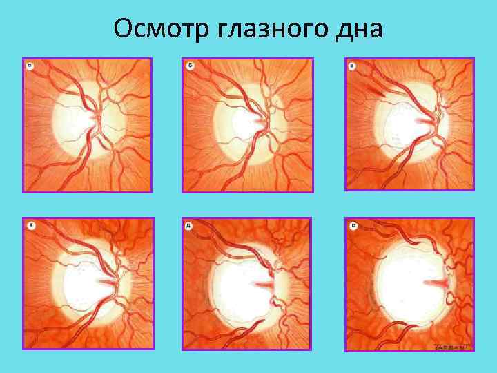 Осмотр глазного дна