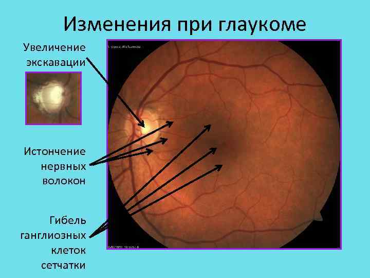 Как определить глаукому компьютерной диагностикой