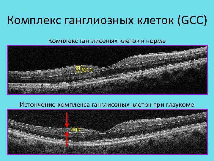 Нервные волокна сетчатки