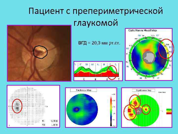Классификация глаукомы. Классификация глаукомы пример записи. Трубка при глаукоме до живота. Значения p<5 при исследовании глаукомы.