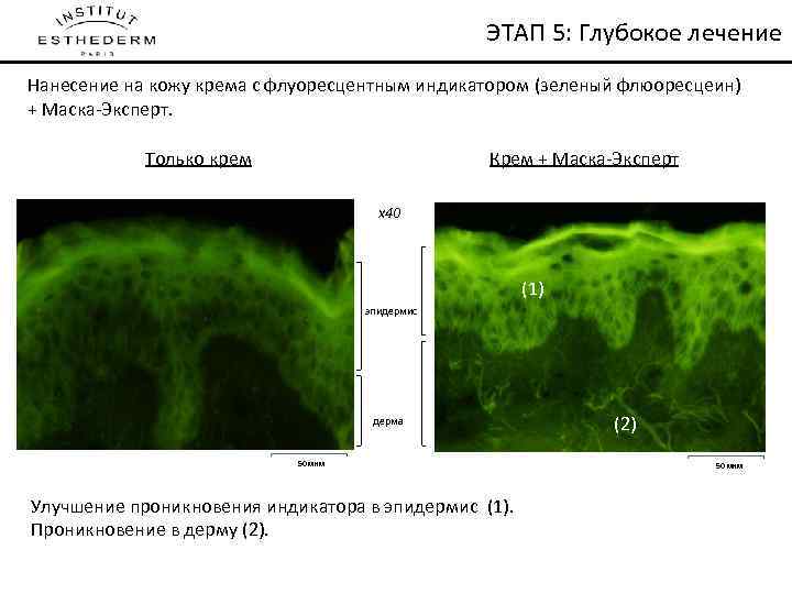 ЭТАП 5: Глубокое лечение Нанесение на кожу крема с флуоресцентным индикатором (зеленый флюоресцеин) +