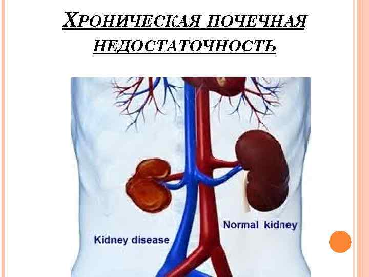 Острая и хроническая почечная недостаточность у детей презентация