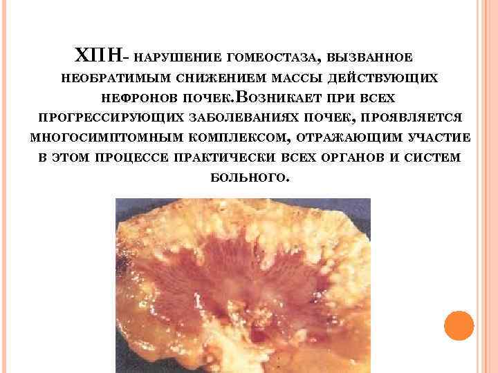 ХПН- НАРУШЕНИЕ ГОМЕОСТАЗА, ВЫЗВАННОЕ НЕОБРАТИМЫМ СНИЖЕНИЕМ МАССЫ ДЕЙСТВУЮЩИХ НЕФРОНОВ ПОЧЕК. ВОЗНИКАЕТ ПРИ ВСЕХ ПРОГРЕССИРУЮЩИХ