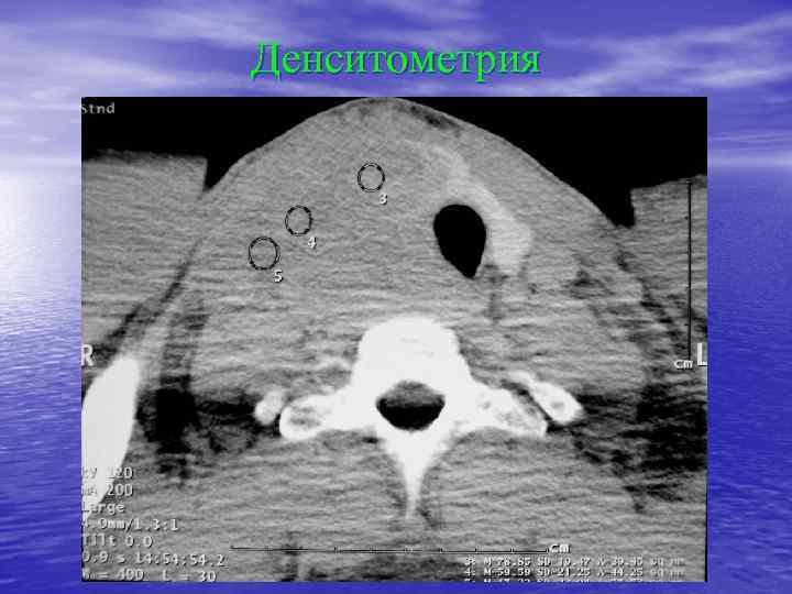 Денситометрия 