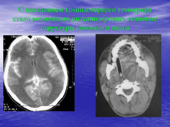 С появлением компьютерного томографа стало возможным визуализировать тканевые структуры головного мозга 