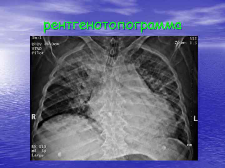 рентгенотопограмма 