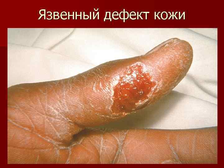 Язвенный дефект кожи 