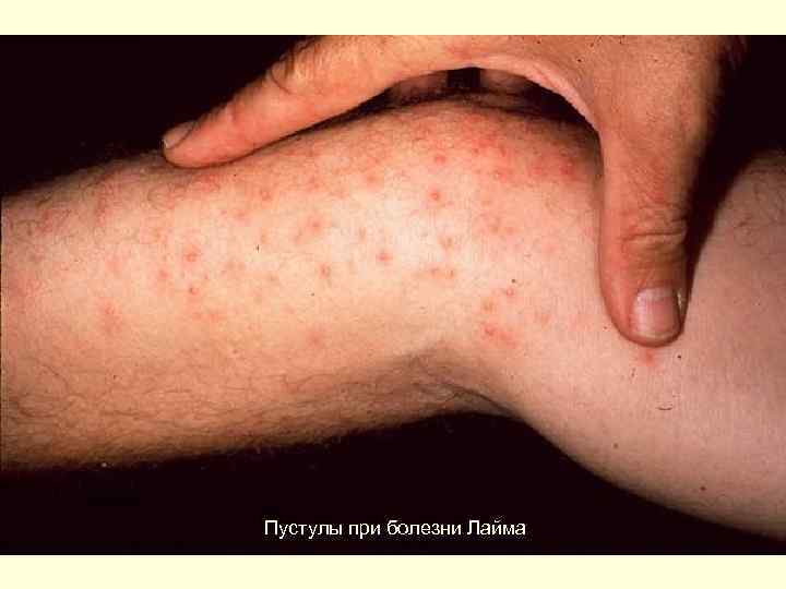Пустулы при болезни Лайма 