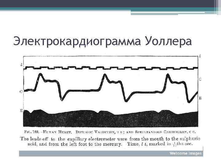Электрокардиограмма Уоллера 