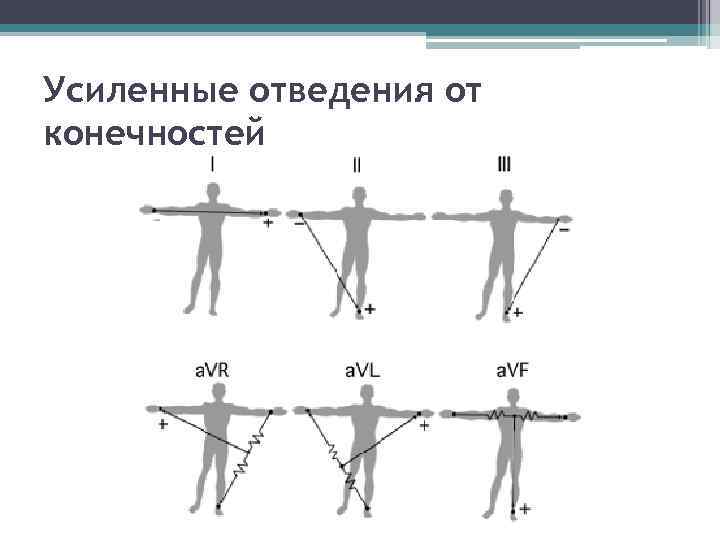 Усиленные отведения от конечностей 