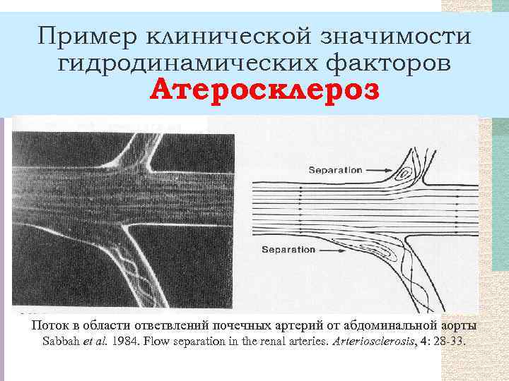 Пример клинической значимости гидродинамических факторов Атеросклероз Поток в области ответвлений почечных артерий от абдоминальной