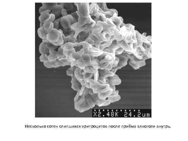 Несколько сотен слипшихся эритроцитов после приёма алкоголя внутрь. 