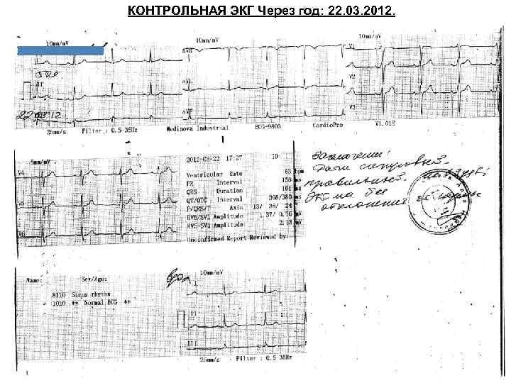 КОНТРОЛЬНАЯ ЭКГ Через год: 22. 03. 2012. 