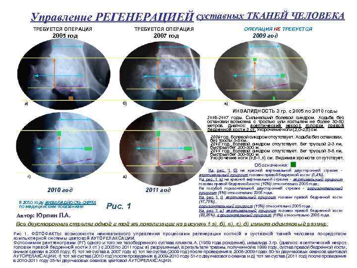 Управление РЕГЕНЕРАЦИЕЙ суставных ТКАНЕЙ ЧЕЛОВЕКА ТРЕБУЕТСЯ ОПЕРАЦИЯ 2005 год а) ОПЕРАЦИЯ НЕ ТРЕБУЕТСЯ 2007