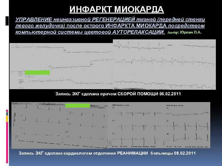 ИНФАРКТ МИОКАРДА УПРАВЛЕНИЕ неинвазивной РЕГЕНЕРАЦИЕЙ тканей (передней стенки левого желудочка) после острого ИНФАРКТА МИОКАРДА