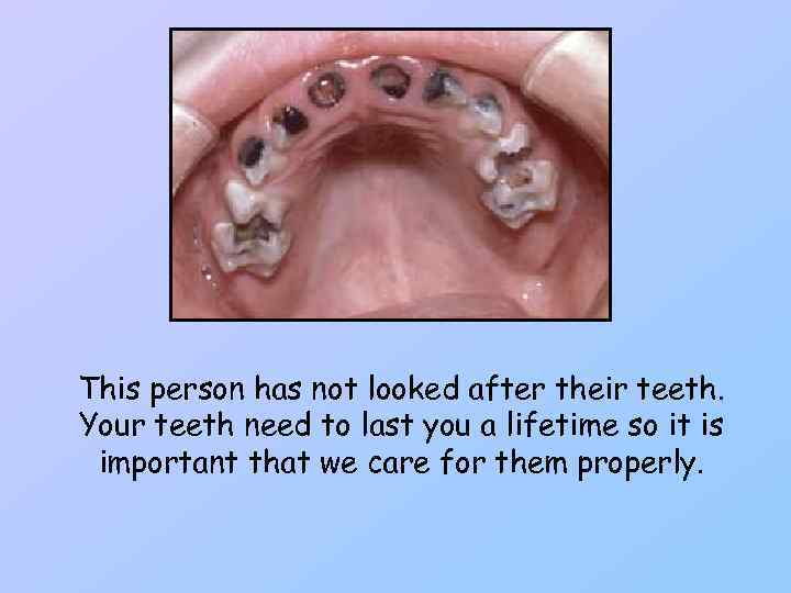 This person has not looked after their teeth. Your teeth need to last you