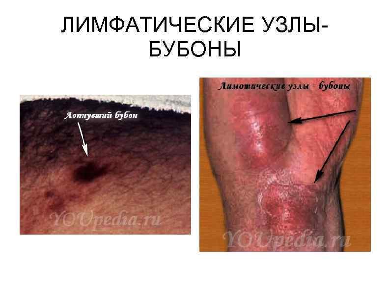ЛИМФАТИЧЕСКИЕ УЗЛЫБУБОНЫ 