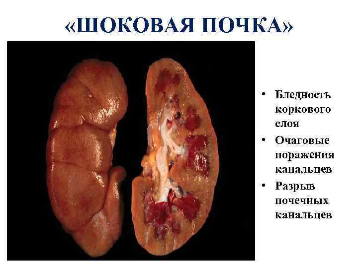  «ШОКОВАЯ ПОЧКА» • Бледность коркового слоя • Очаговые поражения канальцев • Разрыв почечных