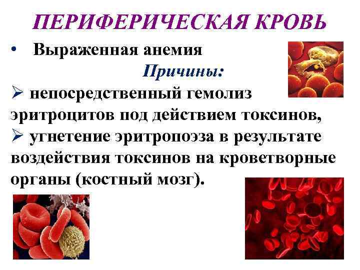 Причины анемии крови. Анемии в результате угнетения эритропоэза. Гемолиз эритроцитов в крови. Факторы вызывающие гемолиз.