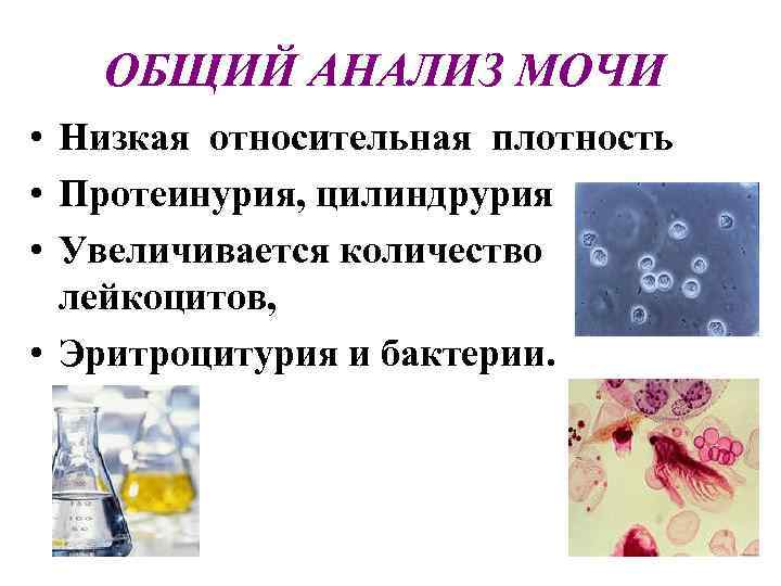 ОБЩИЙ АНАЛИЗ МОЧИ • Низкая относительная плотность • Протеинурия, цилиндрурия • Увеличивается количество лейкоцитов,
