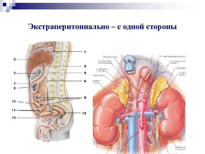 Экстраперитониально – с одной стороны 