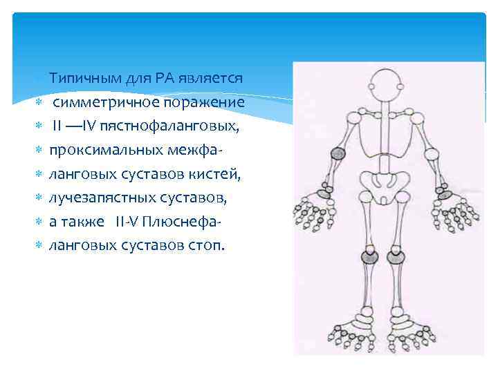  Типичным для РА является симметричное поражение II —IV пястнофаланговых, проксимальных межфаланговых суставов кистей,