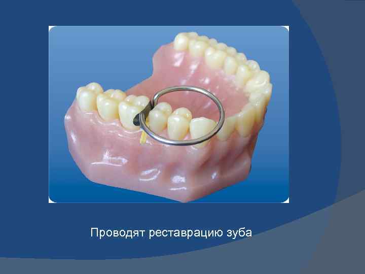 Восстановление между. Контактные пункты зубов. Восстановление контактного пункта зубов. Контактный пункт в стоматологии. Восстановление контактного пункта в стоматологии.