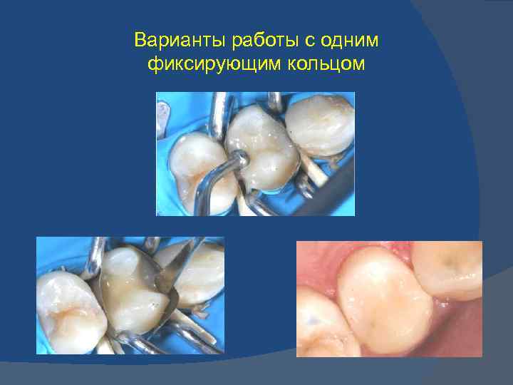 Варианты работы с одним фиксирующим кольцом 