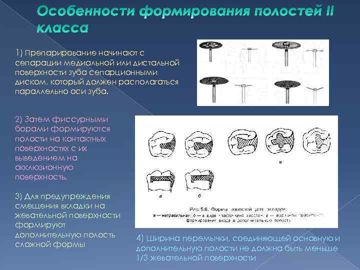 1) Препарирование начинают с сепарации медиальной или дистальной поверхности зуба сепарционными диском, который должен