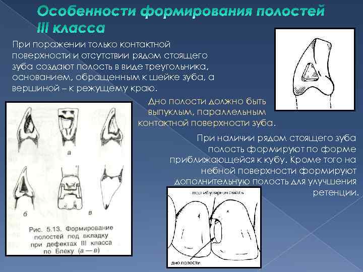 При поражении только контактной поверхности и отсутствии рядом стоящего зуба создают полость в виде