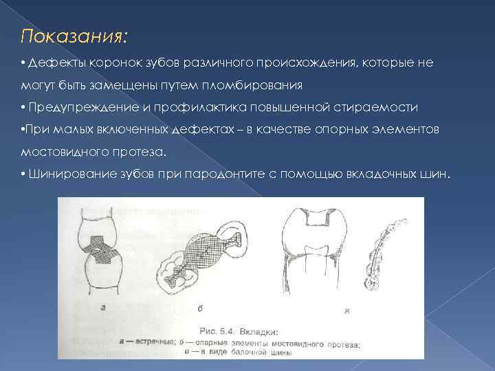 Показания: • Дефекты коронок зубов различного происхождения, которые не могут быть замещены путем пломбирования