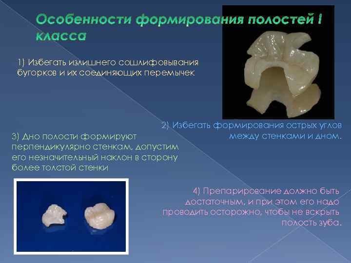 1) Избегать излишнего сошлифовывания бугорков и их соединяющих перемычек 2) Избегать формирования острых углов