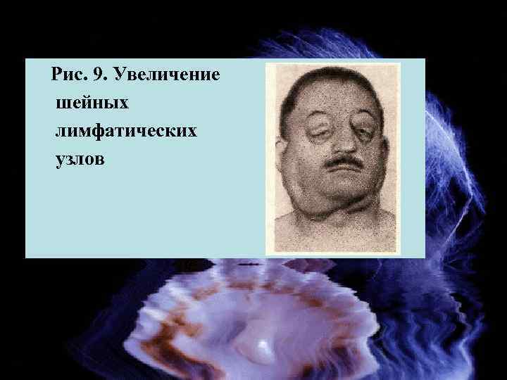 Рис. 9. Увеличение шейных лимфатических узлов 