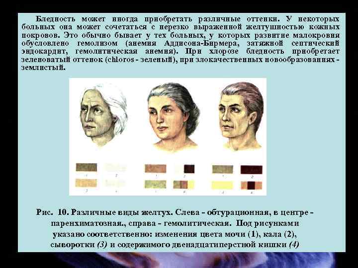 Бледность может иногда приобретать различные оттенки. У некоторых больных она может сочетаться с нерезко