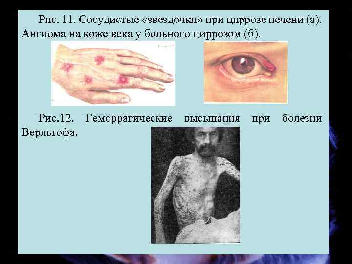 Рис. 11. Сосудистые «звездочки» при циррозе печени (а). Ангиома на коже века у больного