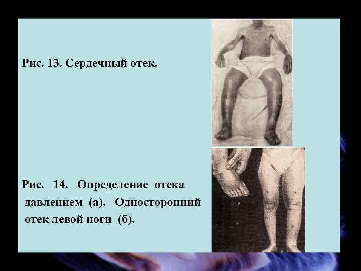 Рис. 13. Сердечный отек. Рис. 14. Определение отека давлением (а). Односторонний отек левой ноги