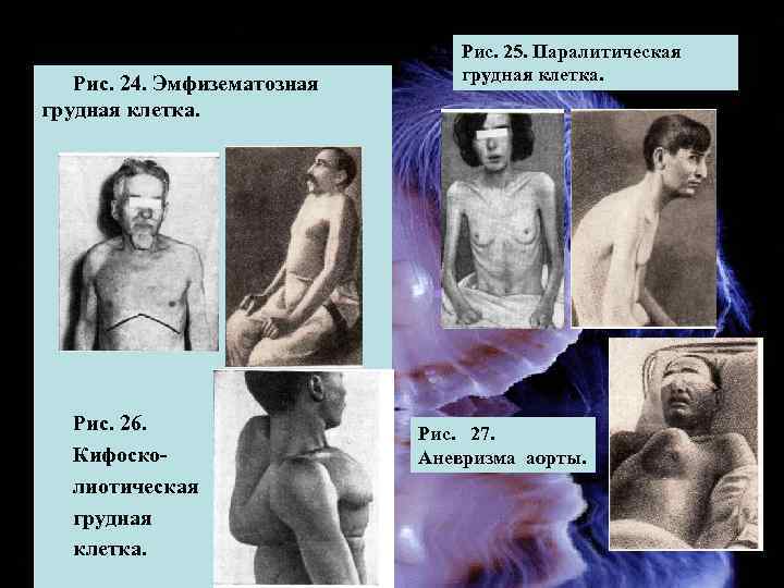 Патологические формы грудной клетки Рис. 25. Паралитическая Рис. 24. Эмфизематозная грудная клетка. Рис. 26.