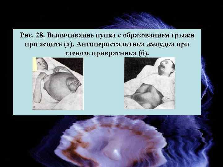 Рис. 28. Выпячивание пупка с образованием грыжи при асците (а). Антиперистальтика желудка при стенозе