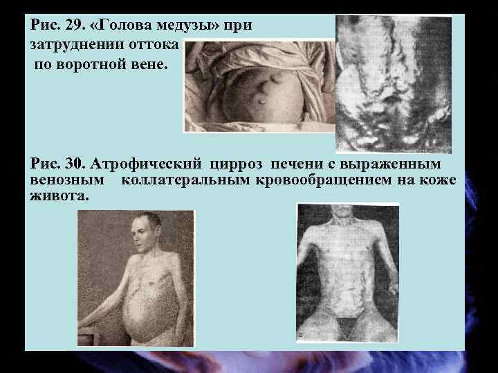 Рис. 29. «Голова медузы» при затруднении оттока по воротной вене. Рис. 30. Атрофический цирроз