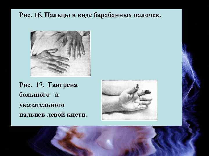 Рис. 16. Пальцы в виде барабанных палочек. Рис. 17. Гангрена большого и указательного пальцев