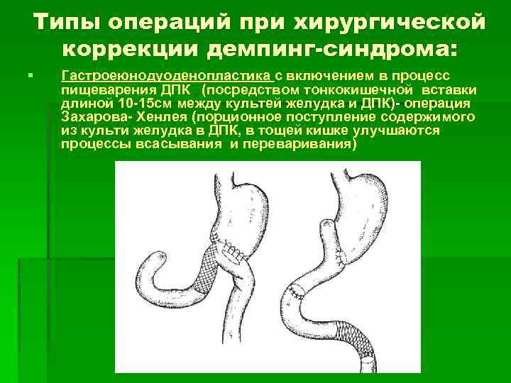 Типы операций при хирургической коррекции демпинг-синдрома: § Гастроеюнодуоденопластика с включением в процесс пищеварения ДПК