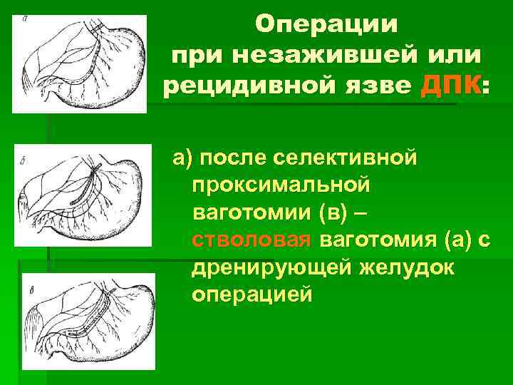 Операции при незажившей или рецидивной язве ДПК: а) после селективной проксимальной ваготомии (в) –