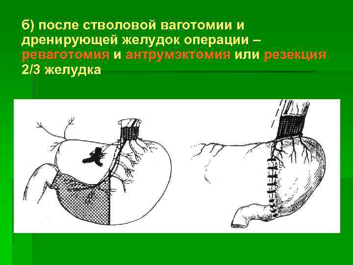 б) после стволовой ваготомии и дренирующей желудок операции – реваготомия и антрумэктомия или резекция