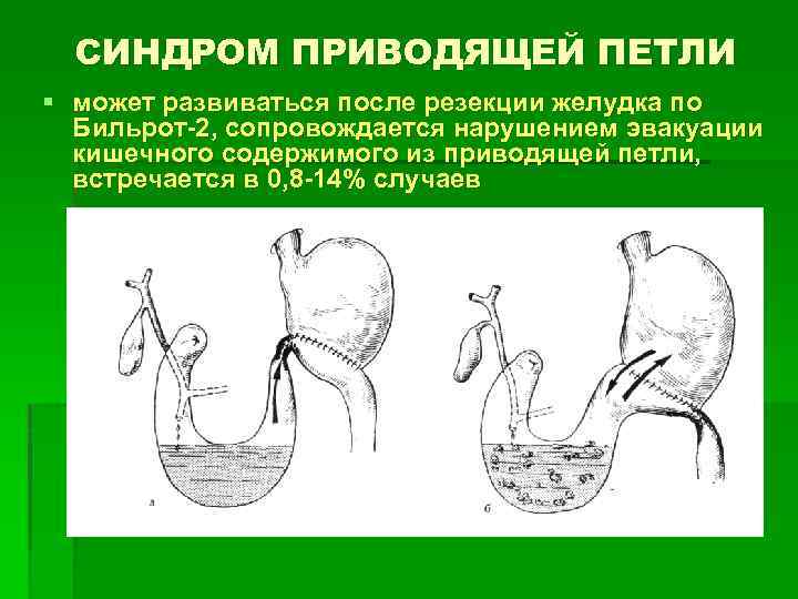 СИНДРОМ ПРИВОДЯЩЕЙ ПЕТЛИ § может развиваться после резекции желудка по Бильрот-2, сопровождается нарушением эвакуации