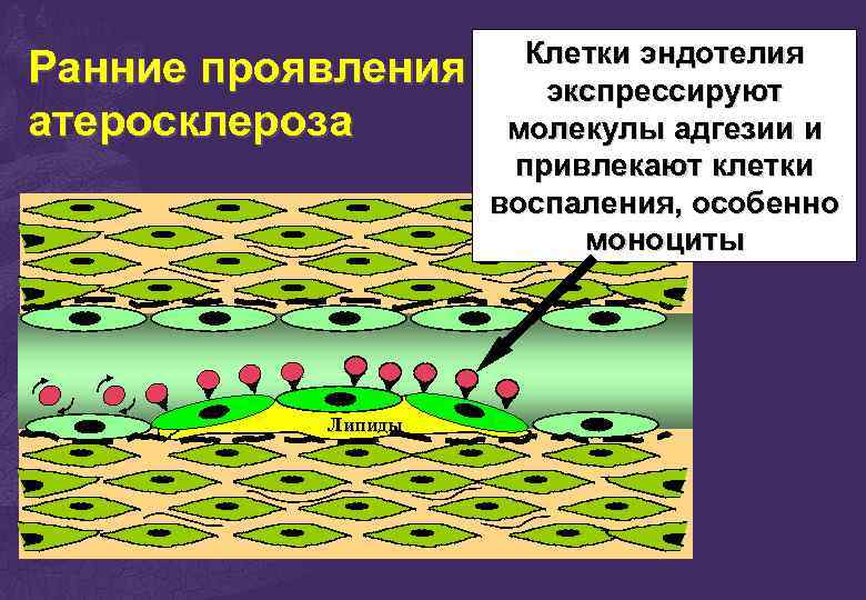 Ранние проявления атеросклероза Липиды Клетки эндотелия экспрессируют молекулы адгезии и привлекают клетки воспаления, особенно