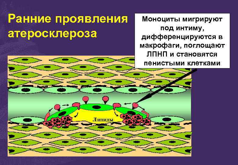 Ранние проявления атеросклероза Липиды Моноциты мигрируют под интиму, дифференцируются в макрофаги, поглощают ЛПНП и