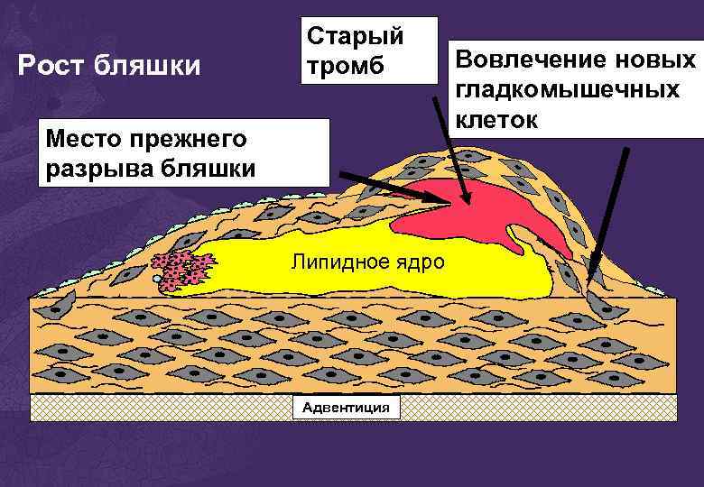 Рост бляшки Старый тромб Место прежнего разрыва бляшки lipid core Липидное ядро Адвентиция Вовлечение