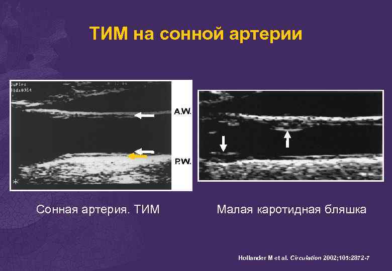 ТИМ на сонной артерии Сонная артерия. ТИМ Малая каротидная бляшка Hollander M et al.